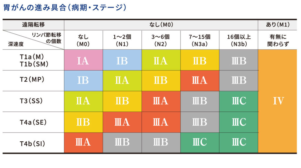 胃がんの進み具合（病期・ステージ）